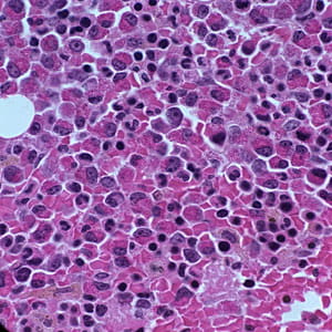 What does it mean if you have elevated eosinophils?